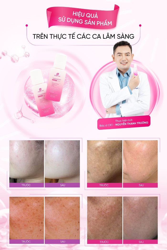 Sử dụng đều đặn 2 lần/ 1 ngày vào buổi sáng và buổi tối liên tục 6-12 tuần để thấy hiệu quả trị nám rõ rệt