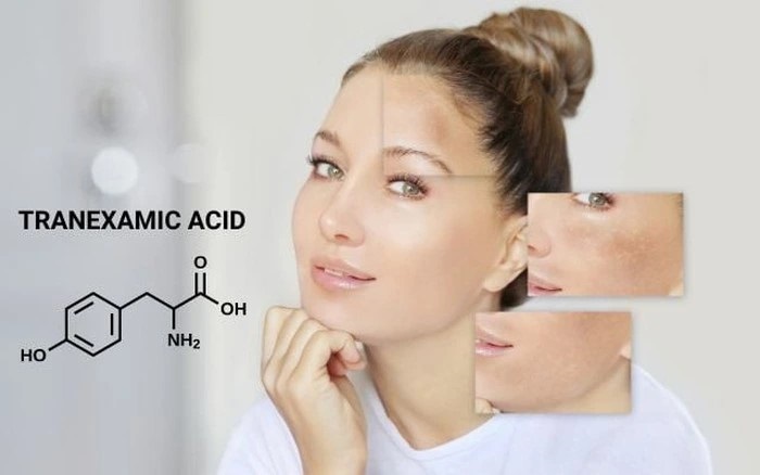 Tranexamic Acid thành phần gạo cội trong làng điều trị thâm nám cho da Tranexamic Acid thành phần gạo cội trong làng điều trị thâm nám cho da
