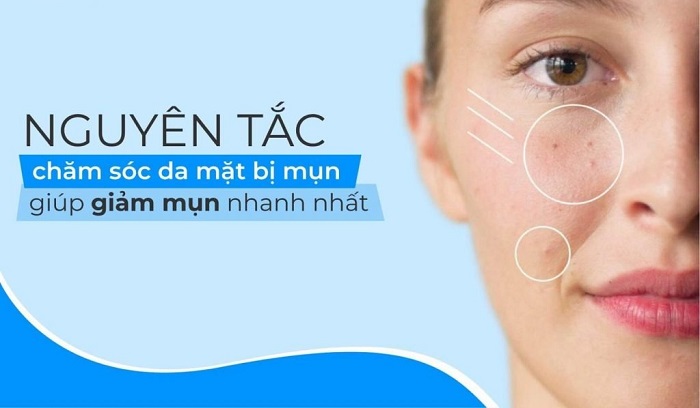 Cách chăm sóc da mụn đúng chuẩn chuyên gia