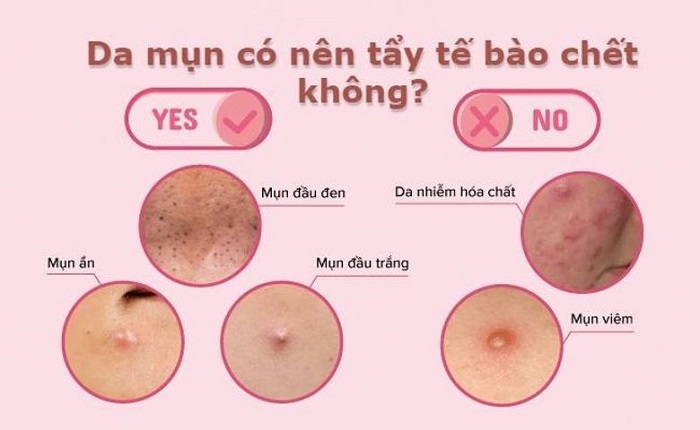 Tẩy da chết cho da mụn định kỳ 1-2 lần/ 1 tuần